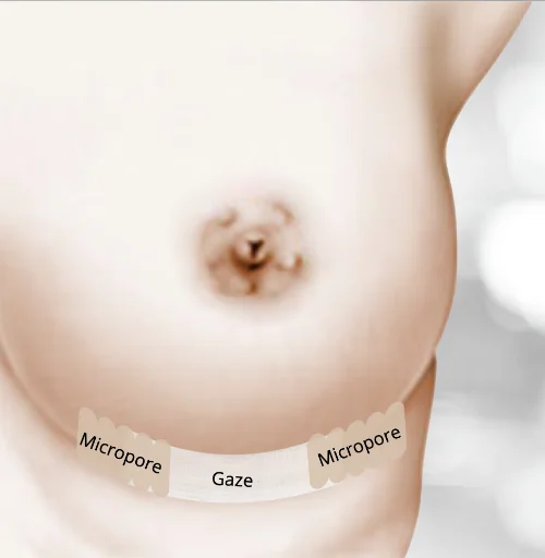 MAMOPLASTIA DE AUMENTO
PRÓTESE DE SILICONE