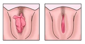 CIRURGIA ÍNTIMA DE LABIOPLASTIA